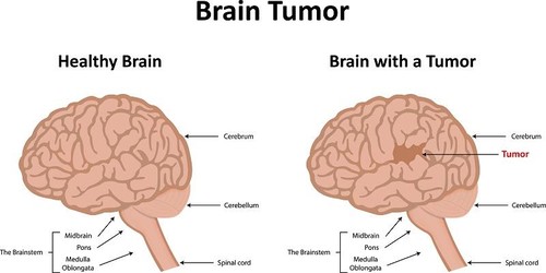 Healthy Brain and Brain With Tumour