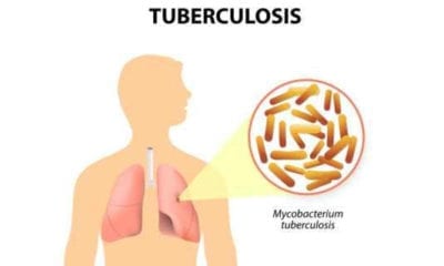 Tuberculosis