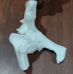 3D Hip Model for the Yemen Blast victim