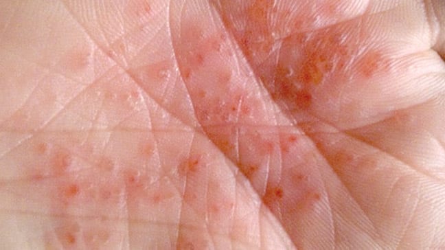 5627 dyshidrotic eczema 648x364 slide2