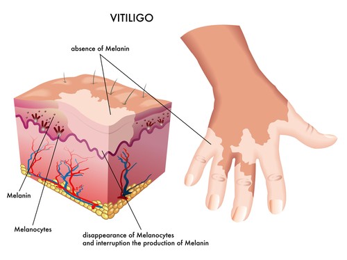 Causes of Vitiligo