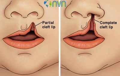 Cleft lip Surgery