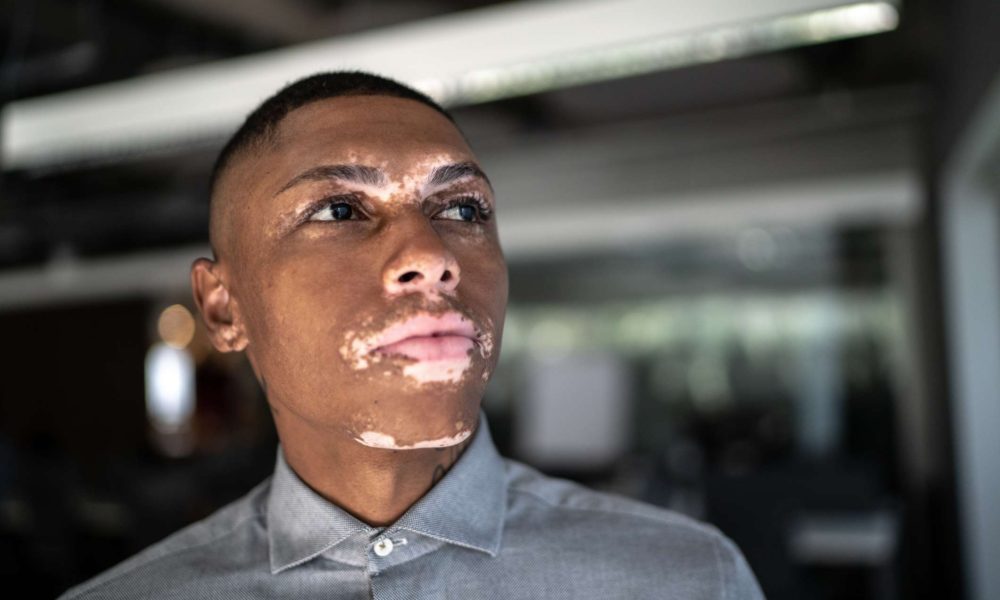 Vitiligo, Signs & the Stigma associated with it