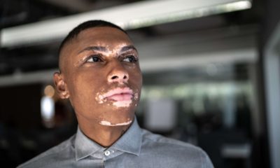 Vitiligo, Signs & the Stigma associated with it