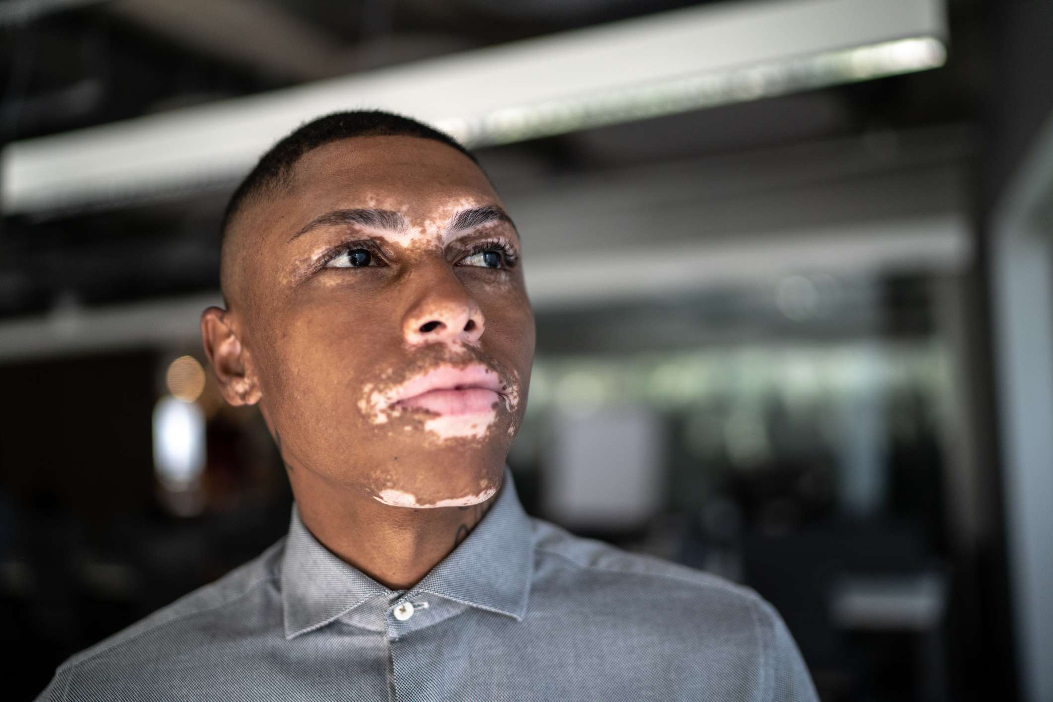 Vitiligo, Signs & the Stigma associated with it