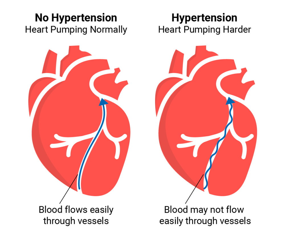 Blood Pressure and Hypertension