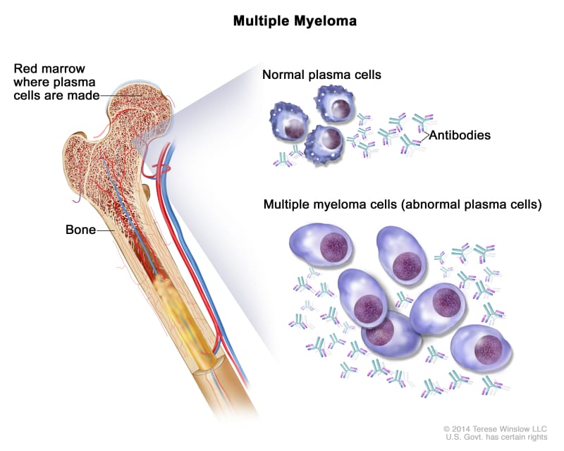 Multiple myeloma 1