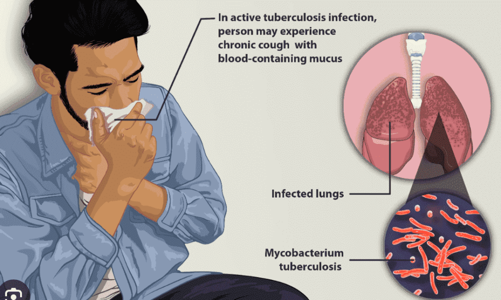 Completion of TB treatment - all patients should be followed up - Why?