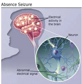 Causes of absence seizure