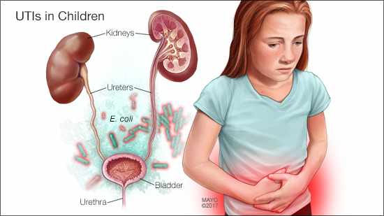 a medical illustration of the kidneys ureters bladder and urethra with E. coli in the background and a young girl holding her belly and looking distressed illustrating UTIs in children original