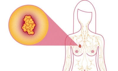 breast cancer facts what is breast cancer