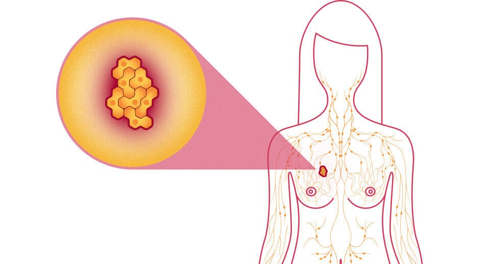 breast cancer facts what is breast cancer
