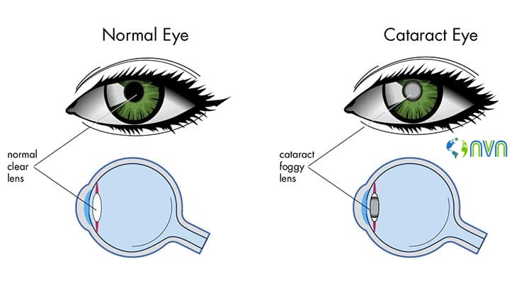 cataract-eye-crossection-copy