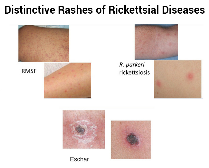 Child Critical With Rickettsial Infection And Covid Gets Timely Treatment 138 Distinctive rashes of rikettsial diseases