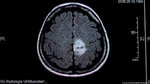 Brain scan detecting tumour 