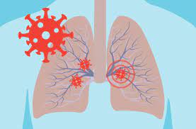 Covid 19 And Your Lungs