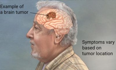 Understanding Brain Tumors: Causes, Symptoms and Treatment