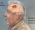 Understanding Brain Tumors: Causes, Symptoms and Treatment