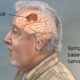 Understanding Brain Tumors: Causes, Symptoms and Treatment