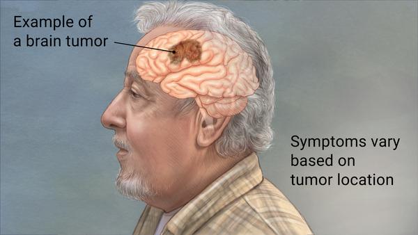 Understanding Brain Tumors: Causes, Symptoms and Treatment