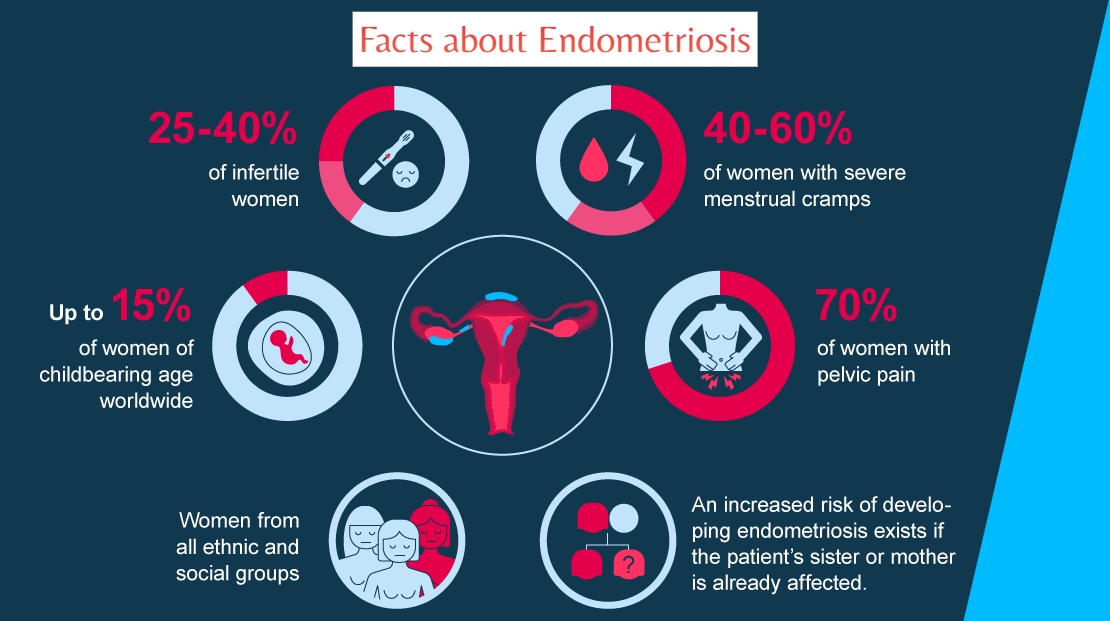 Endometriosis leading cause of Infertility in Women due to Delayed Diagnosis