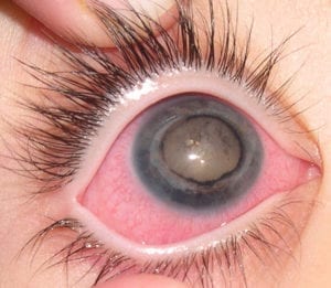 eye tumour1