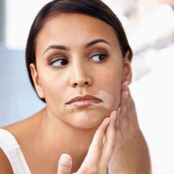 Vitiligo happens around the lips