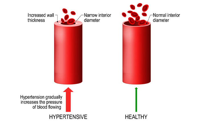 Difference between a hypertensive and a healthy heart