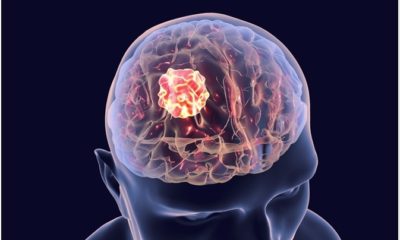 Brain Tumour Treatment During Covid - Can It Be Delayed?