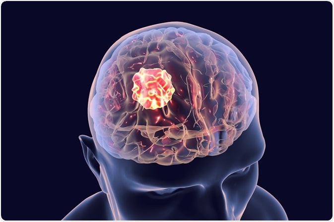 Brain Tumour Treatment During Covid - Can It Be Delayed?