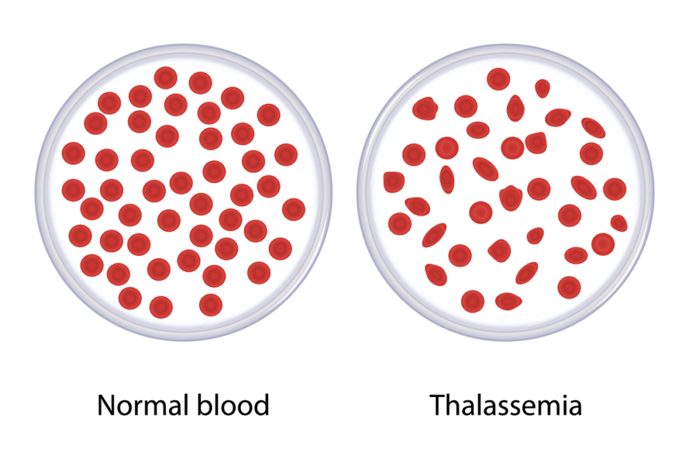 Thalassemia