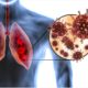 Are You Suffering From Lung Infection? Be Careful Of COVID-19!