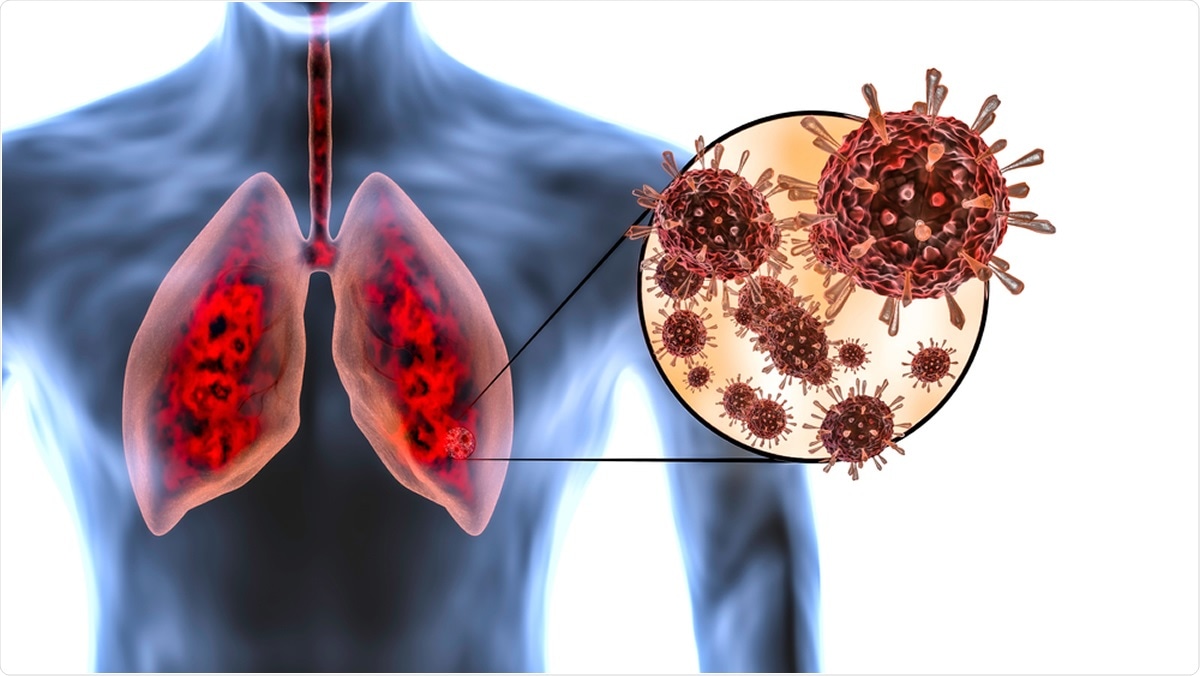 Are You Suffering From Lung Infection? Be Careful Of COVID-19!