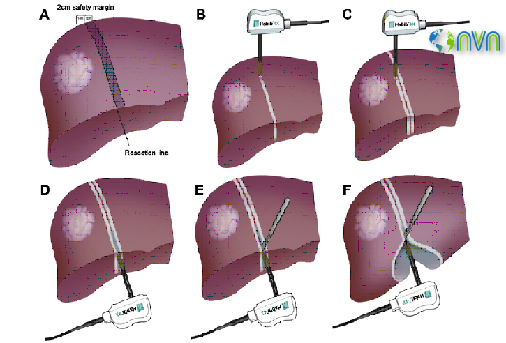 liver resection at HCG Mumbai