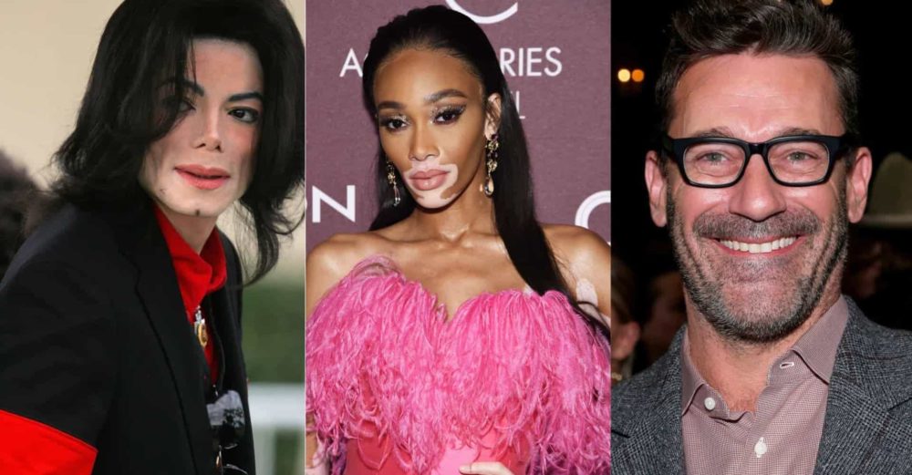 Celebrities with Vitiligo