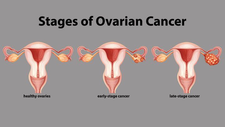 Stages of Ovarian Cancer