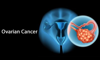 Ovarian Cancer – Delay In Prognosis Increases The Burden
