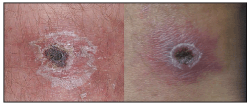 Child Critical With Rickettsial Infection And Covid Gets Timely Treatment 139 Rickettsial rashes