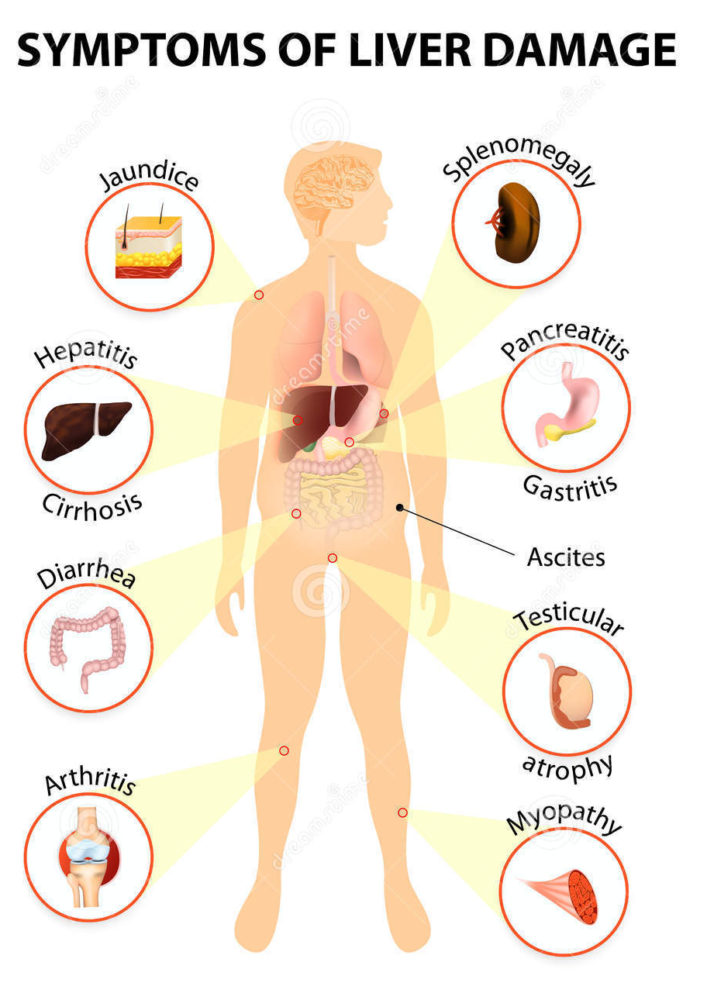 Symptoms of liver damage