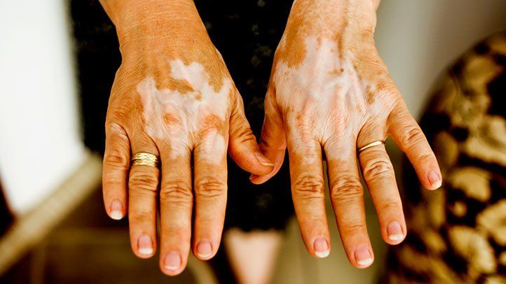 Vitiligo, Skin Disease